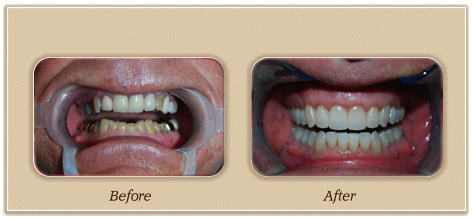 dental crowns before and after pic