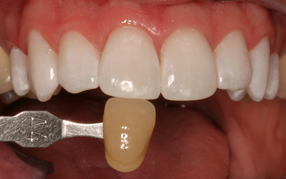 whitening after
